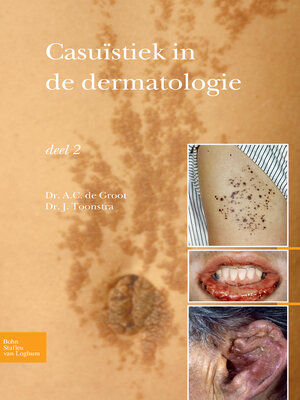 cover image of Casuïstiek in de dermatologie--deel 2